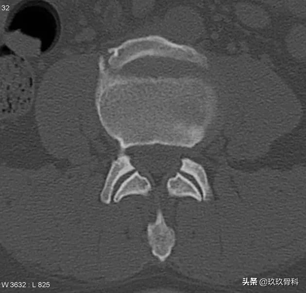 病例实讲|你是否也将其误诊为椎体骨折