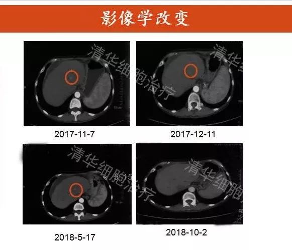 nkt治疗对什么肿瘤有效,nkt治疗适合哪种癌症