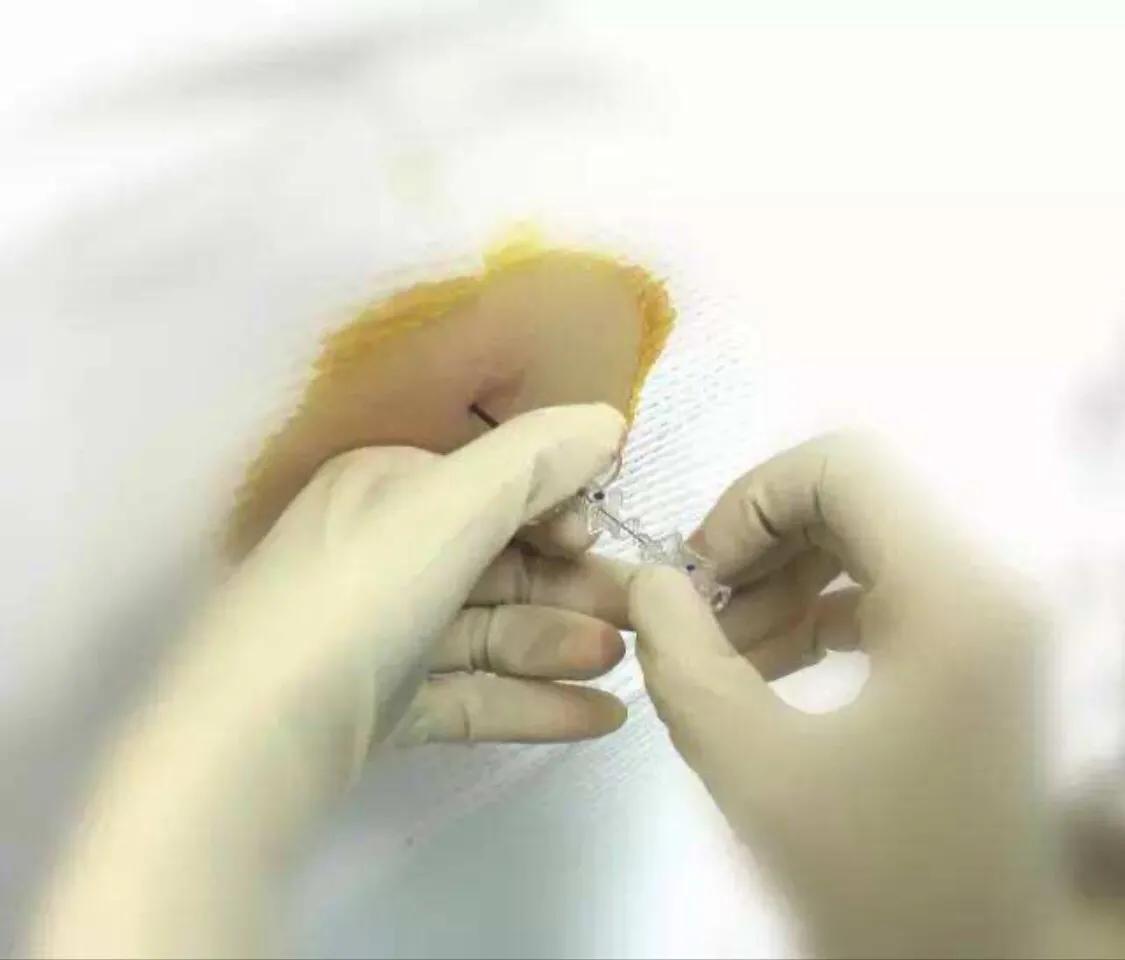 腰麻后是不是尾椎会疼,腰麻后脊椎骨会疼正常吗