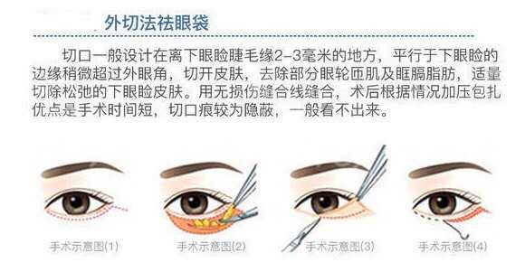 如何消除眼袋呢,如何消除眼袋浮肿