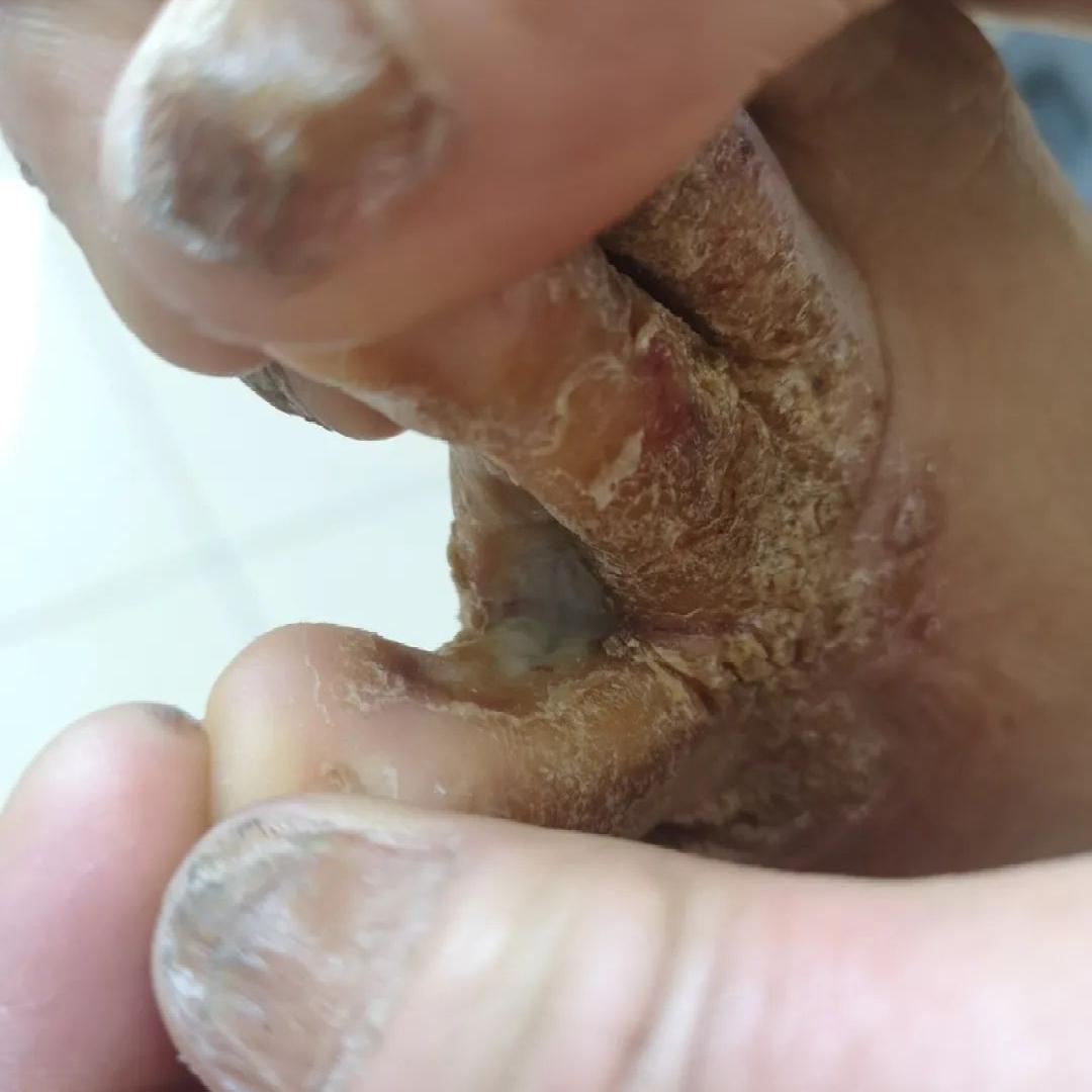 你以为的脚气还不是脚气