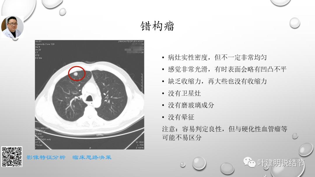 叶建明谈肺实性小结节视频,廖正银教授谈肺结节