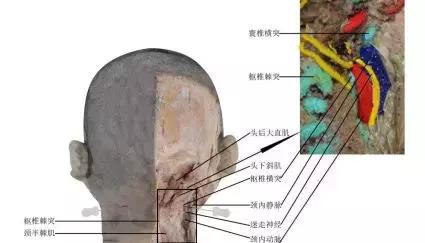 颈源性头痛中医治疗,颈源性头痛中药处方