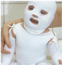 湿疹皮炎怎么治疗才能好,湿疹皮炎的最佳治疗方法