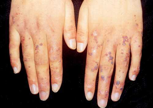手上红点不痛不痒像血痣,手上不痛不痒的红点