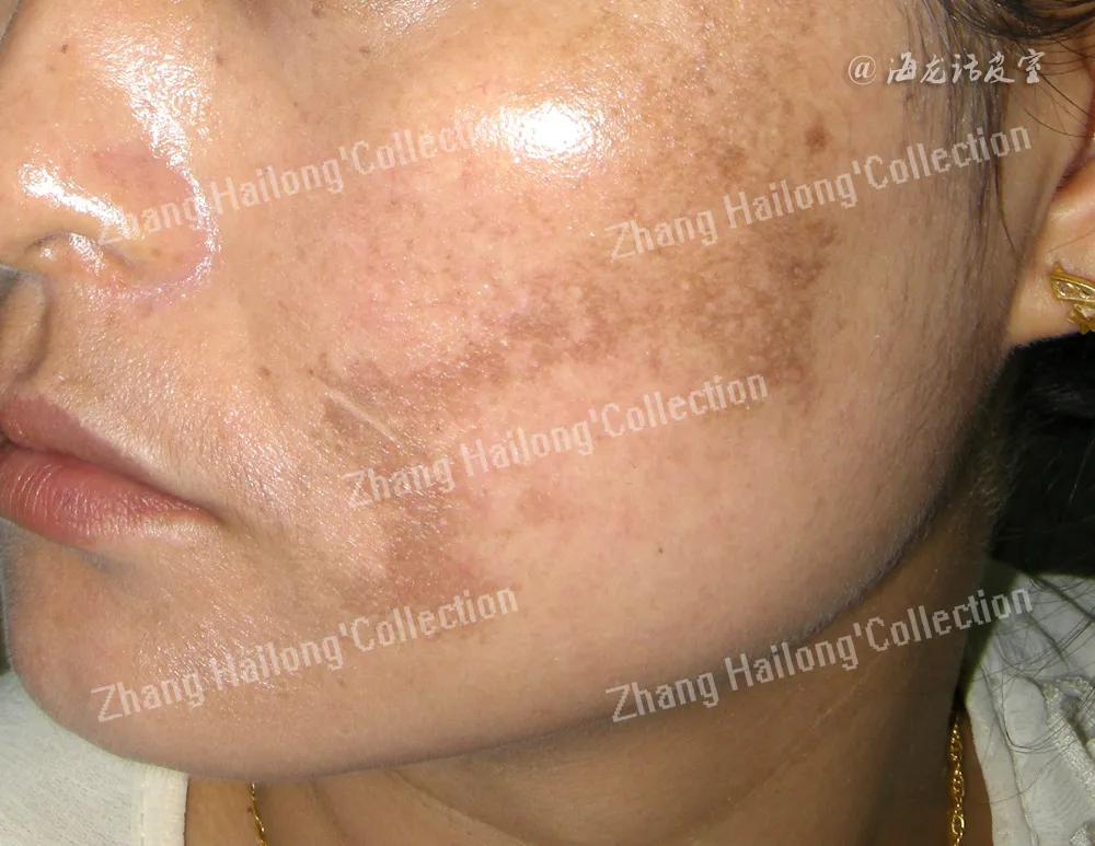 褐斑怎么治用什么药,脸黄长褐斑