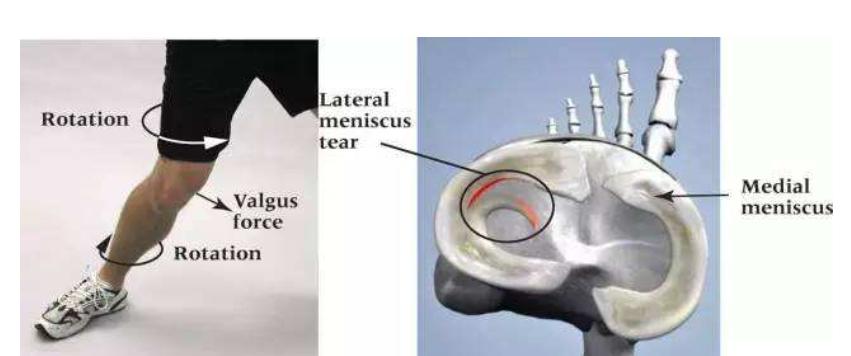 半月板像肉筋还是板筋,半月板最容易损伤的瞬间