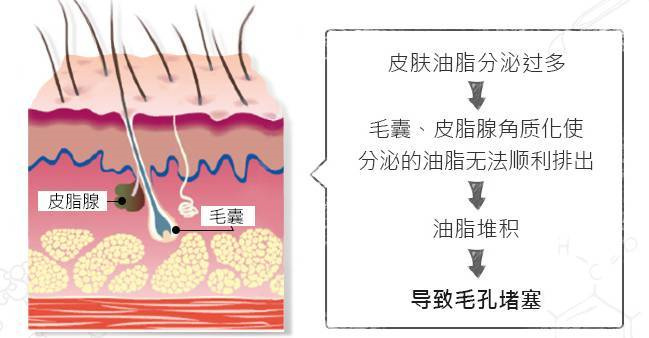 油皮出油严重怎么涂散粉,油皮怎么不用化妆品改善出油