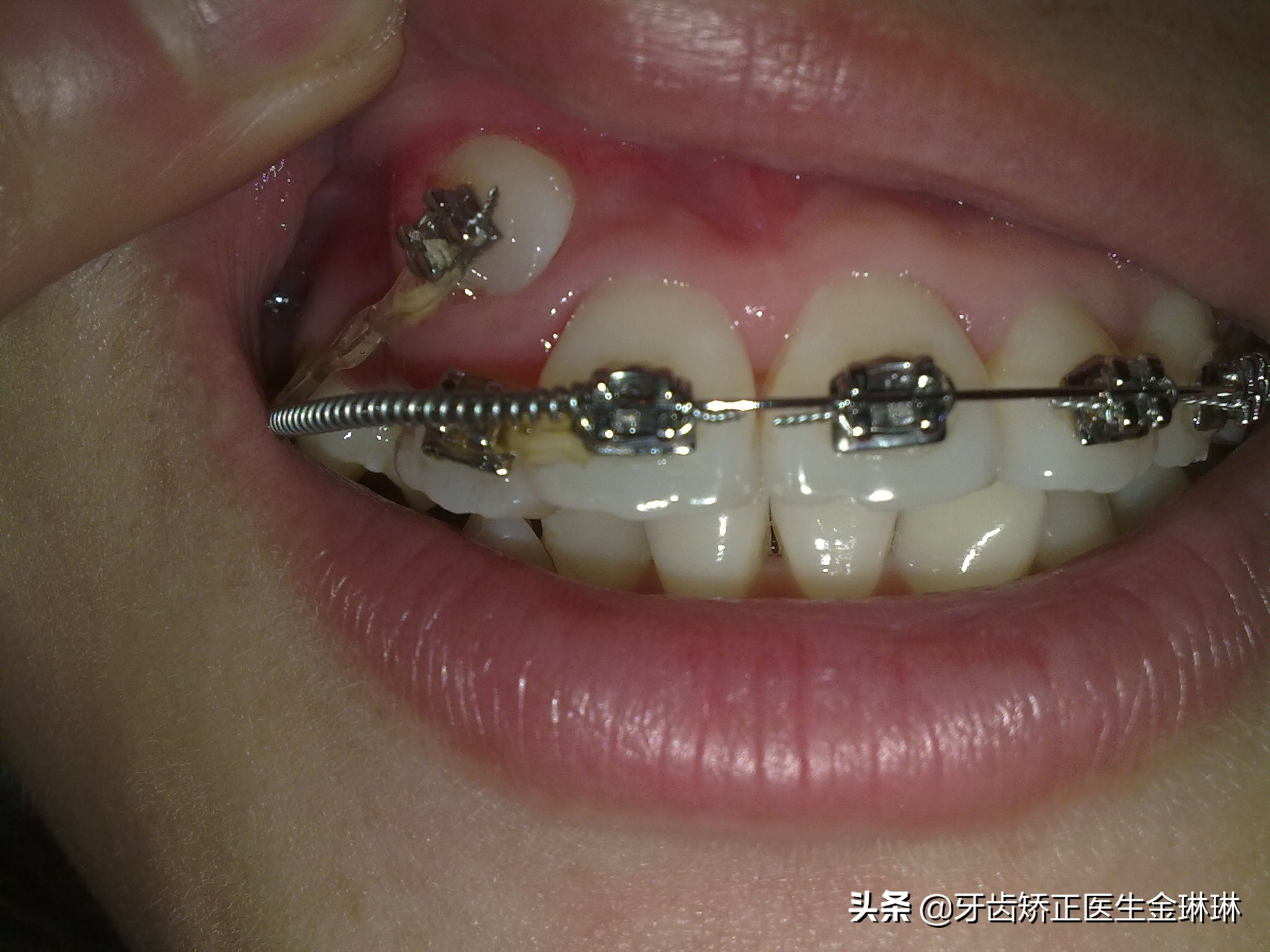 老虎牙可以戴牙套矫正吗,老虎牙做矫正