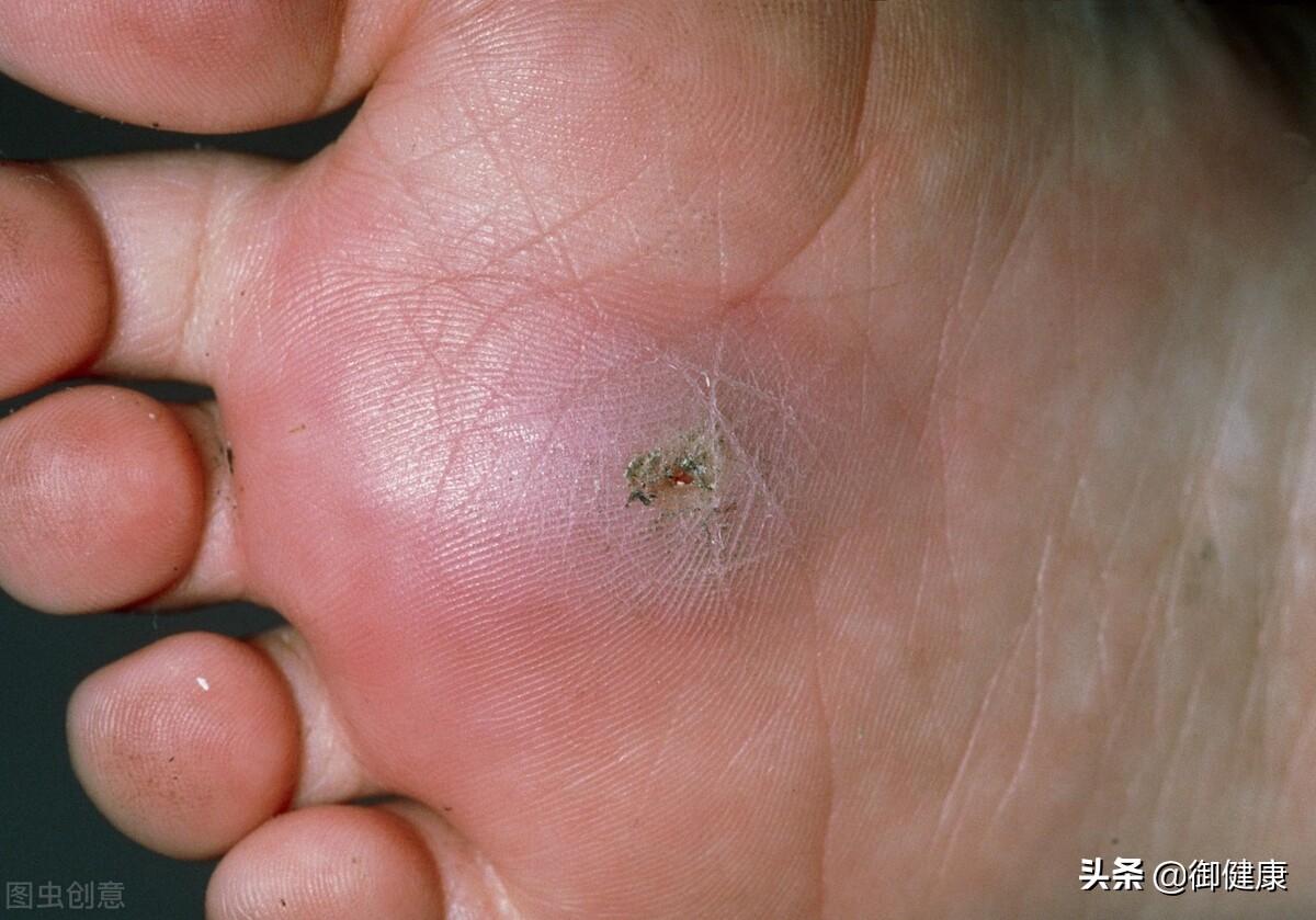 破伤风科普口诀,医学破伤风知识点总结