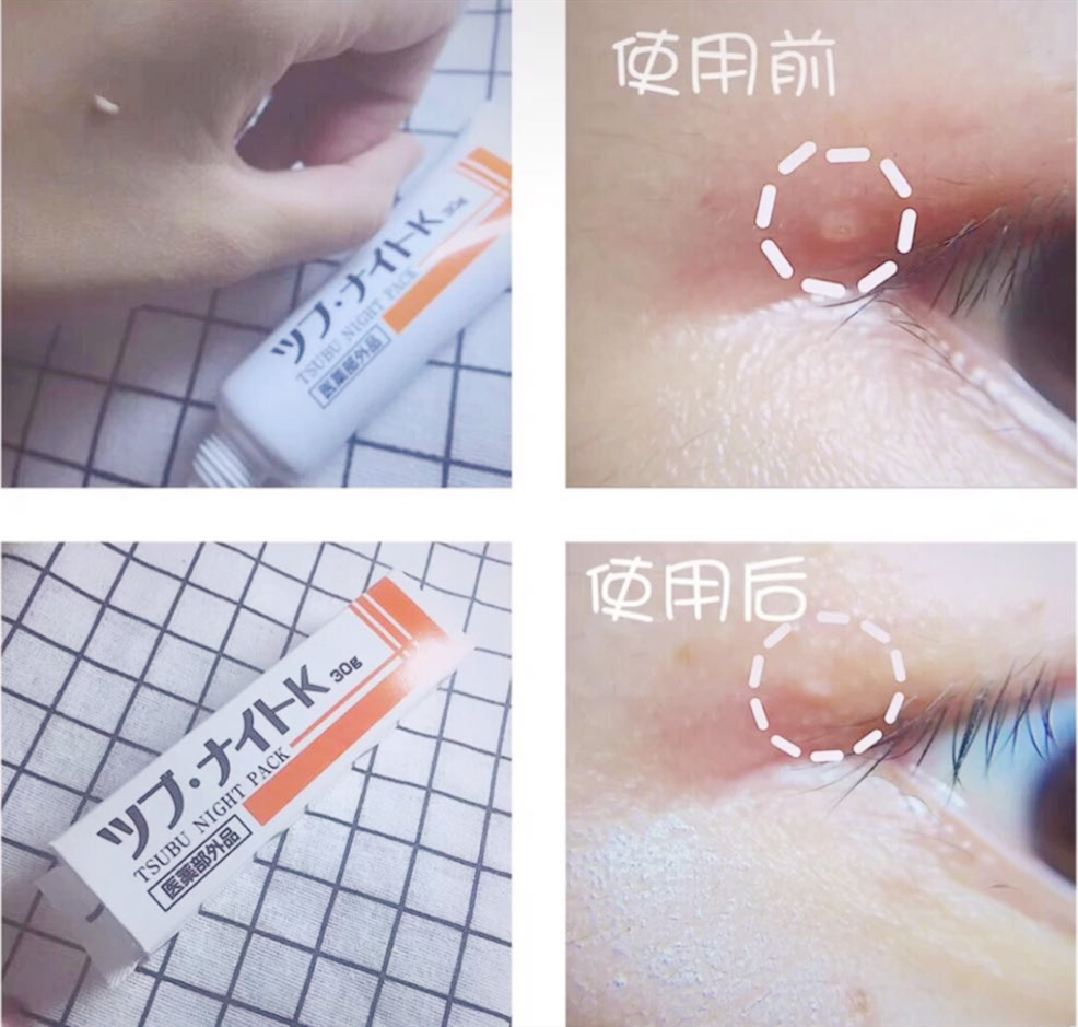 脂肪粒去粒神器 (日本自动消除脂肪粒)