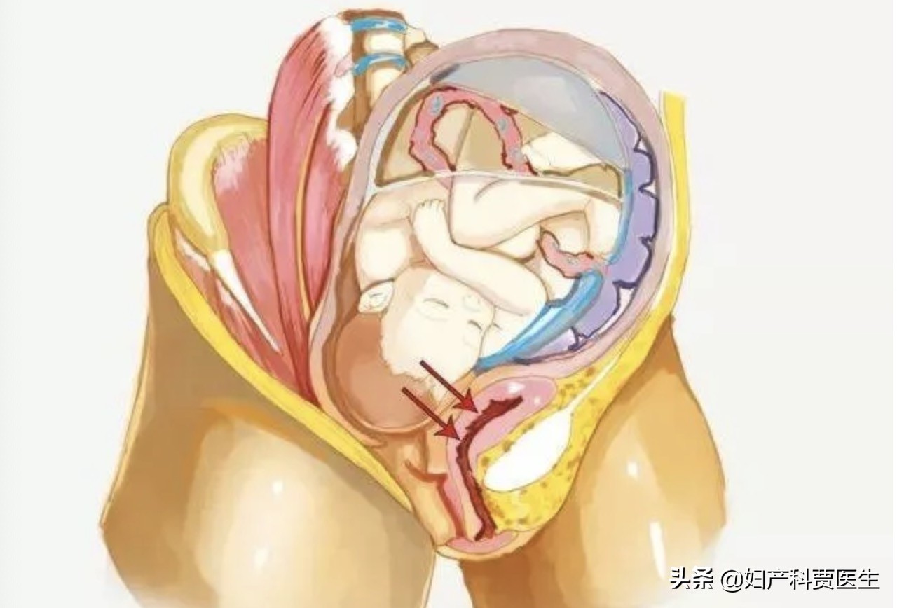 产后修复盆底肌需要去专业地方吗,什么情况下需要做产后盆底肌修复