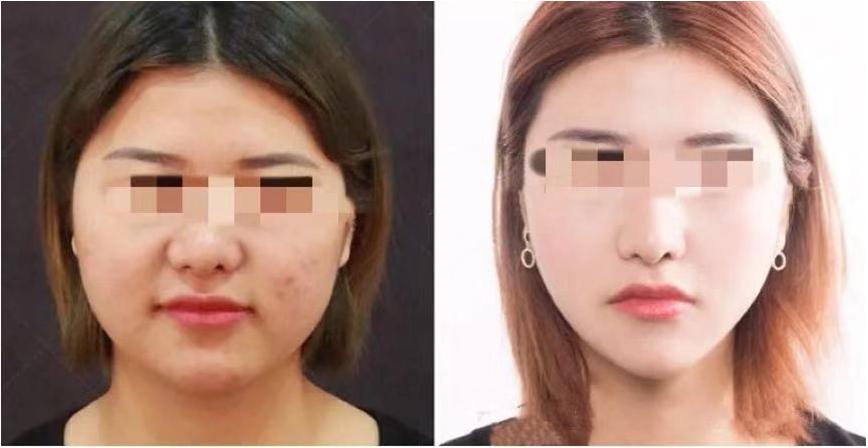 双下巴,嘟嘟肉,成年人的婴儿肥到底该肿么办?