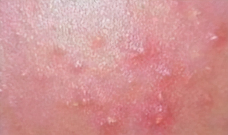 挤痘是正确的吗,关于挤痘痘的几点忠告