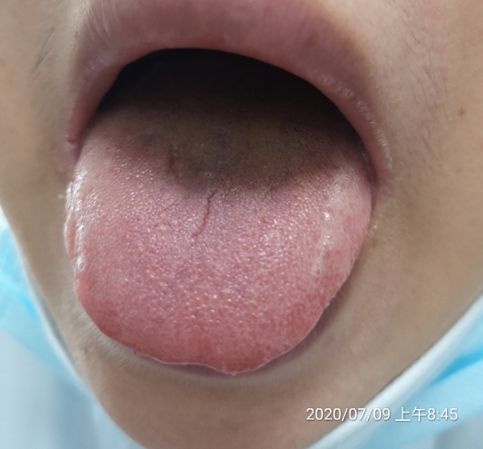 治疗耳石症的五种中成药,有没有治疗耳石症的西药