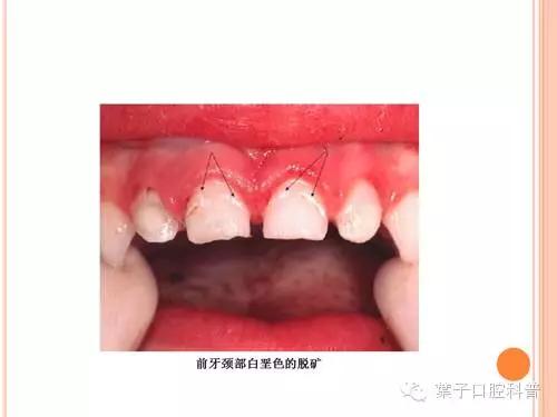 牙齿涂氟小知识,有氟牙可以涂氟吗