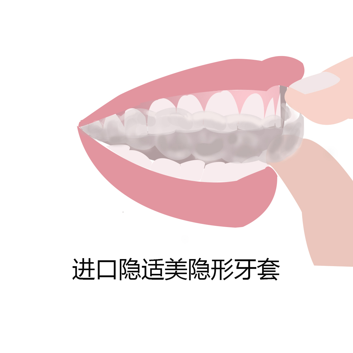现在牙套有几种哪种好,牙套哪种最好