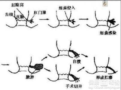 肛周脓肿的预防和治疗方法,肛周脓肿的治疗原则和注意事项