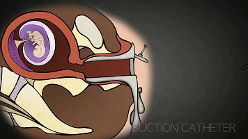 我用七次流产,换来这条血的教训