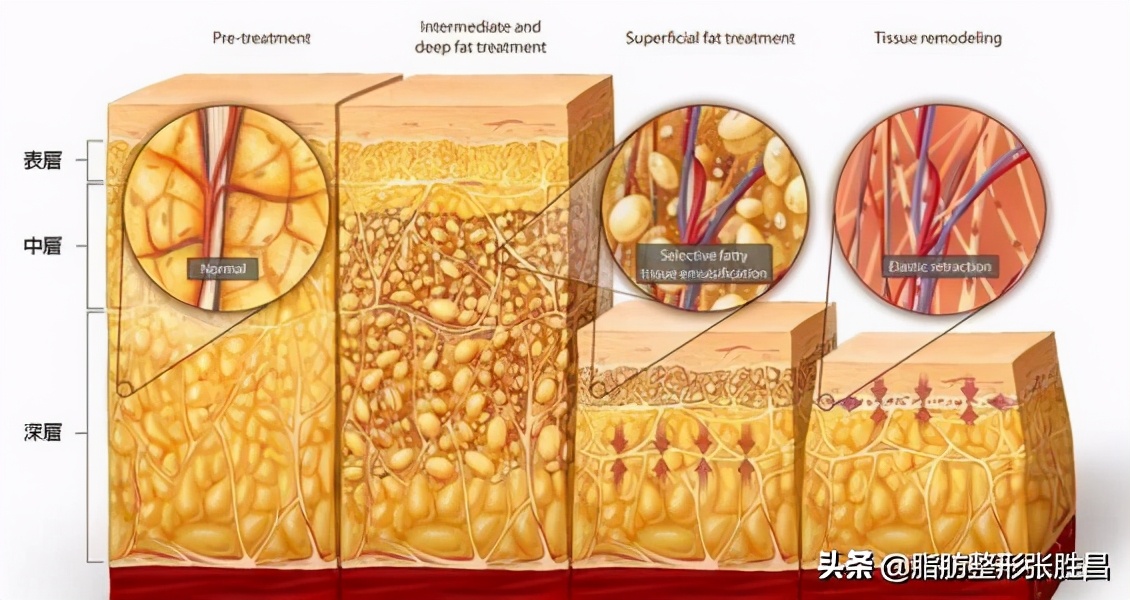 为什么吸脂会吸出血水是失败了吗,吸脂血水多有效果吗