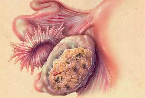 怀孕检查出来卵巢癌,以为怀孕了结果出现肿瘤