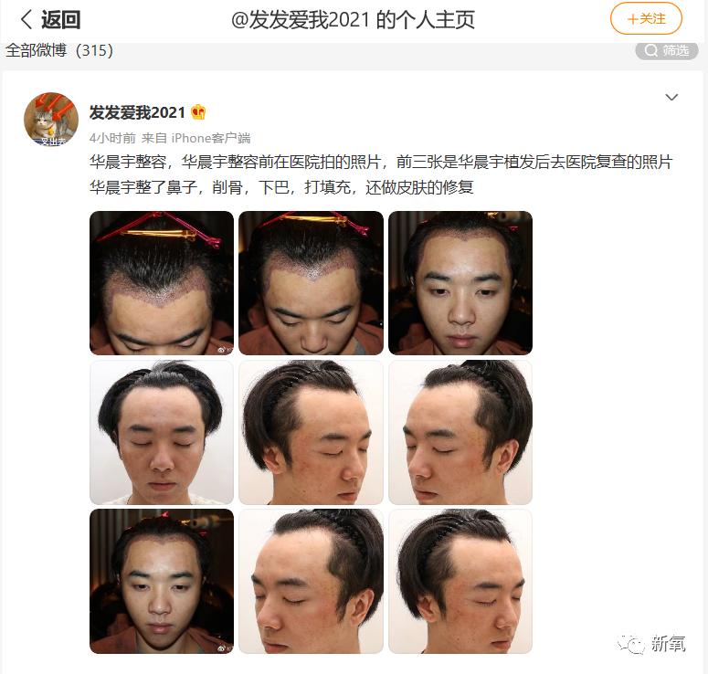华晨宇整前整后对比,华晨宇最近又整脸了么