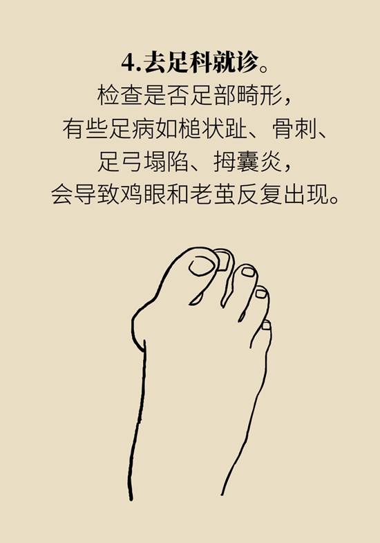 长了鸡眼该怎么办四大妙招教给你,长了鸡眼怎么治疗好得快