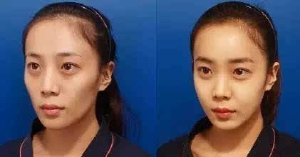 脸颊松弛凹陷怎么能变圆润,脸部凹陷显老怎么办