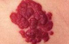 宝宝胎记的症状有哪些,宝宝出生有胎记是怎么来的