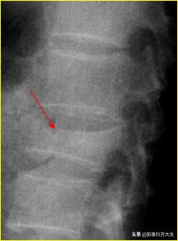 骨折的影像学检查及各自的优势,骨折的影像学愈合标准