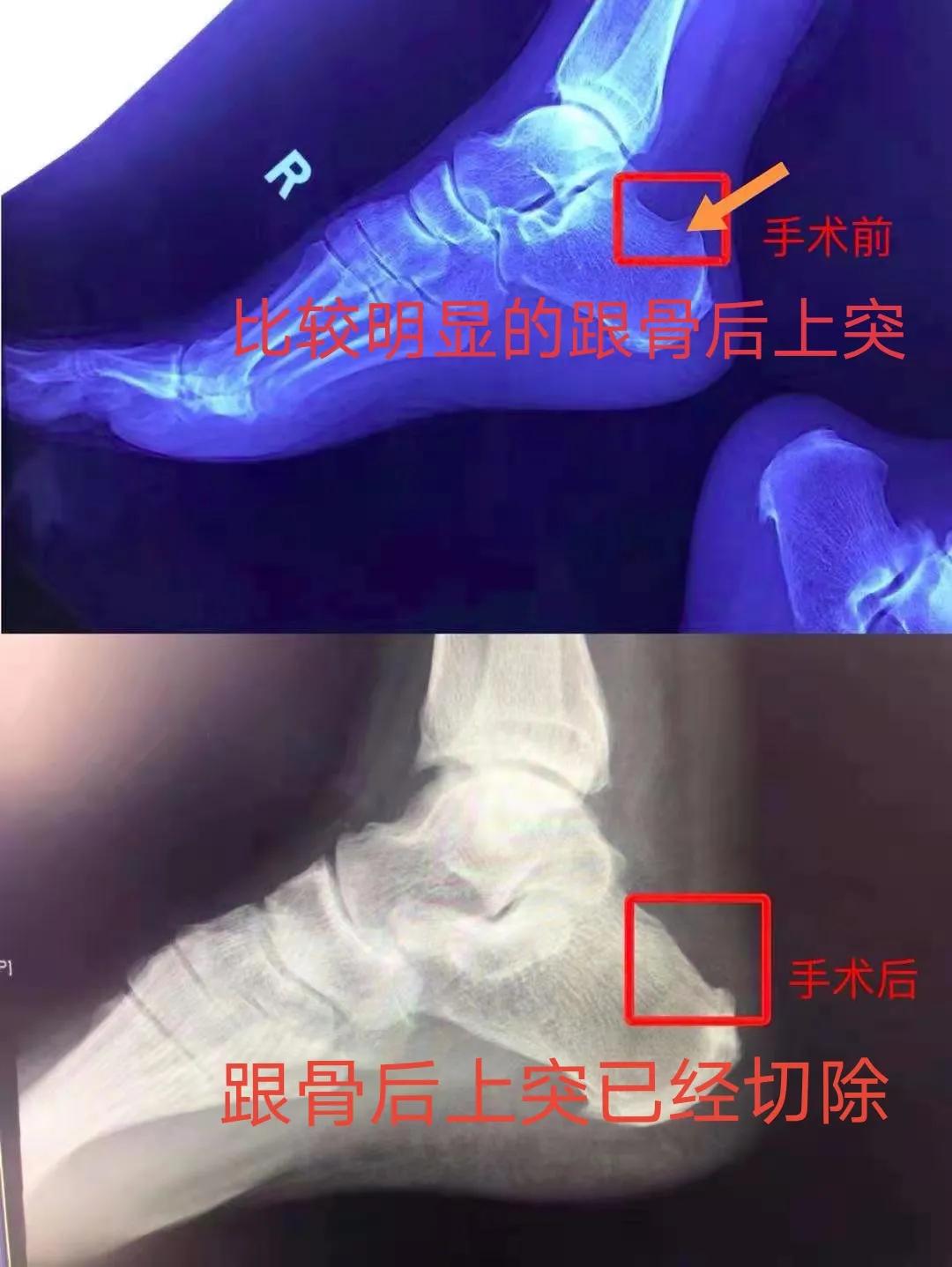 这种足跟痛是怎么回事？——跟骨后上突过大引发的Haglund病