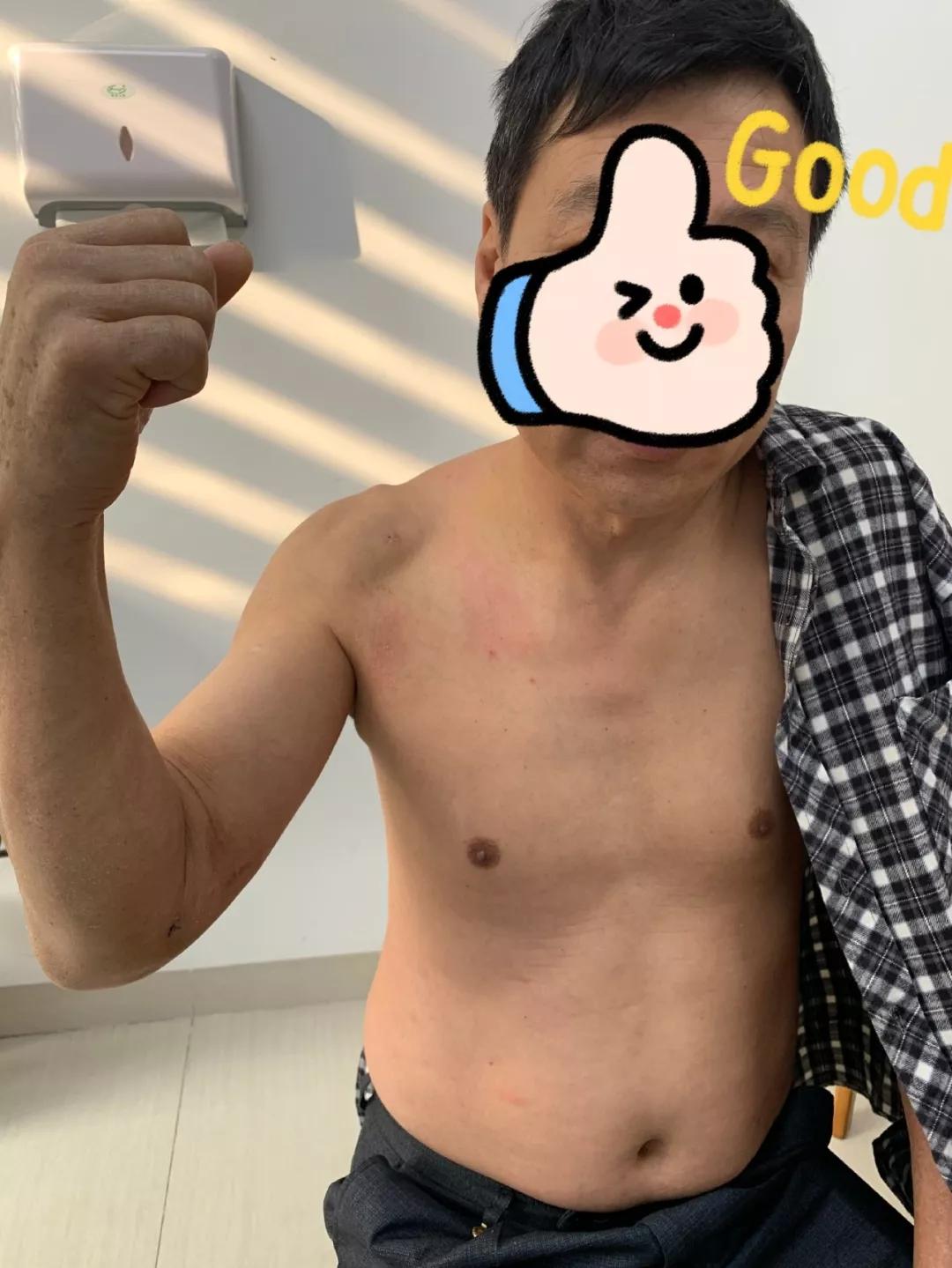 肩袖损伤肘关节旋转康复训练,肩关节损伤治疗微创视频