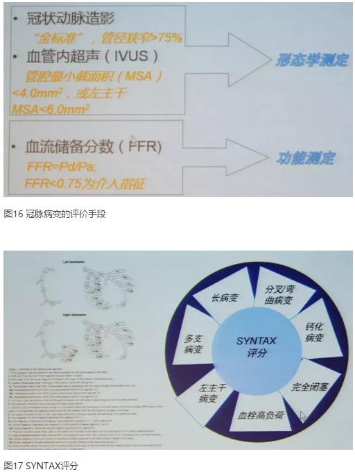 清晰完整揭秘冠脉造影全部过程,冠脉造影教学视频