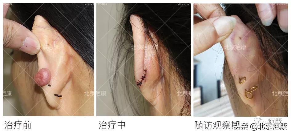 耳垂肉内长了个硬疙瘩,耳垂长个硬疙瘩是什么病的前兆