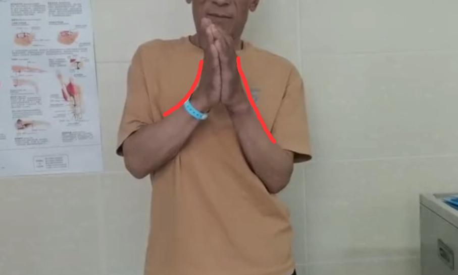 腕关节针刀松解术视频,腕关节松解术