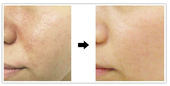 祛痘印痘坑收缩毛孔微针,微针美容是否适合你一份详细指南