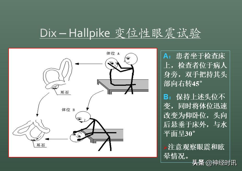 良性位置性眩晕诊断和治疗指南,良性阵发性位置性眩晕的诊断标准