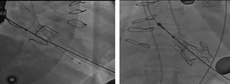 70岁心脏扩大换瓣膜成功率多大,老人心脏瓣膜缺失不做手术行吗