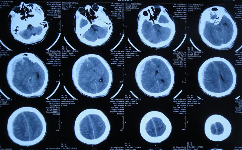 开颅手术后颅内细菌感染图片,外伤开颅手术后脑积液能恢复吗