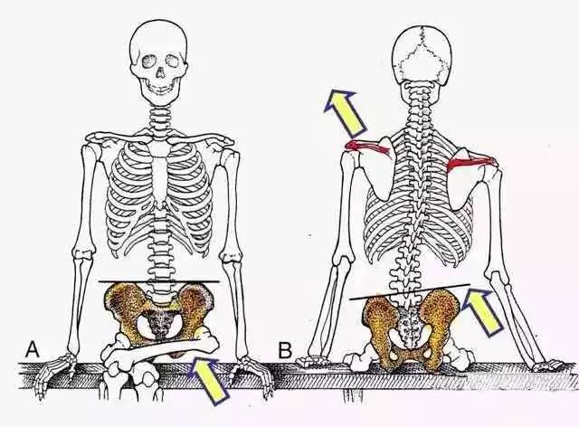 改善跷二郎腿的骨盆倾斜,骨盆倾斜可以反向跷二郎腿吗