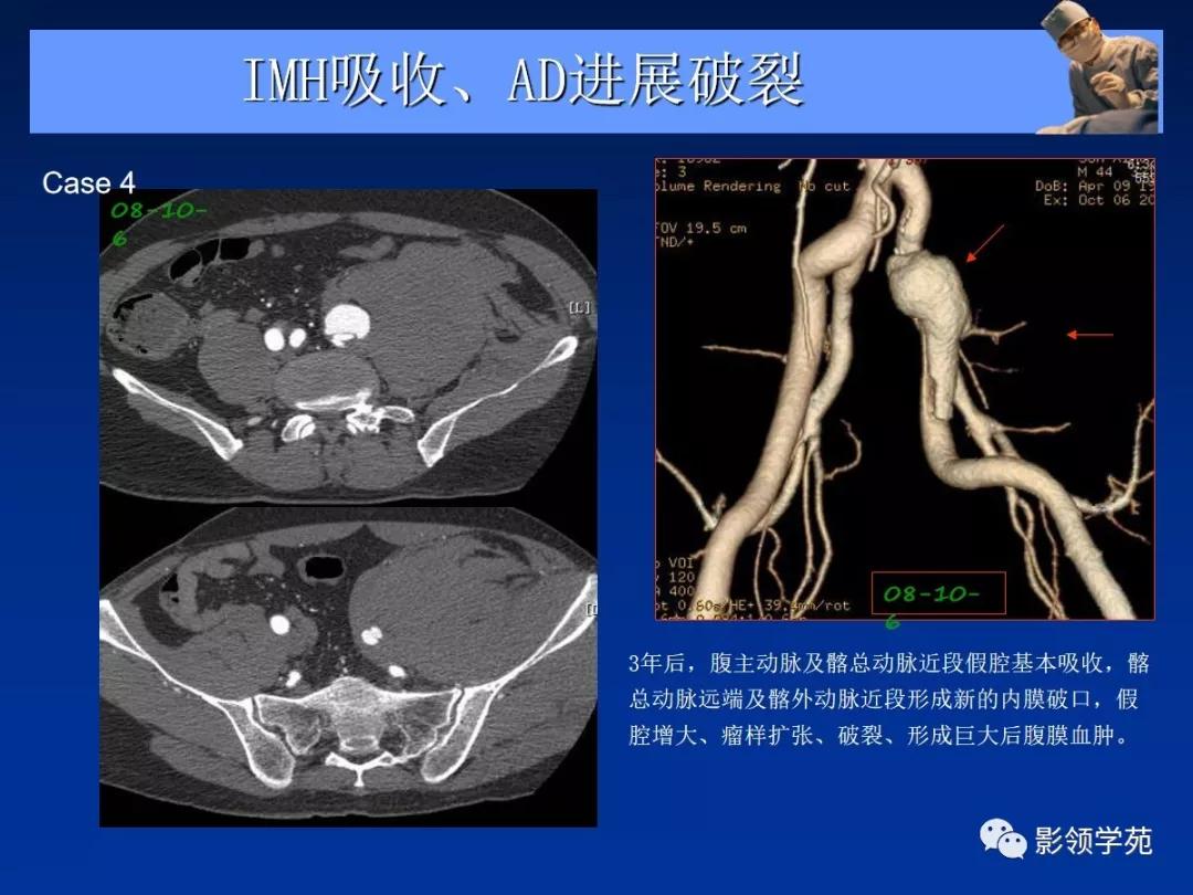主动脉夹层壁间血肿如何鉴别,主动脉夹层血肿溃疡