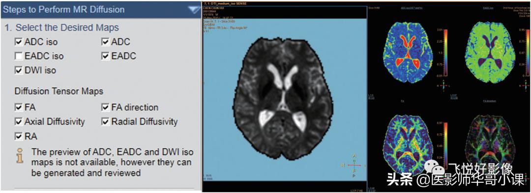 飞利浦磁共振波谱成像扫描技术,飞利浦磁共振纵隔扫描技术