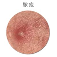 痘痘中医怎么解释,痘痘中医