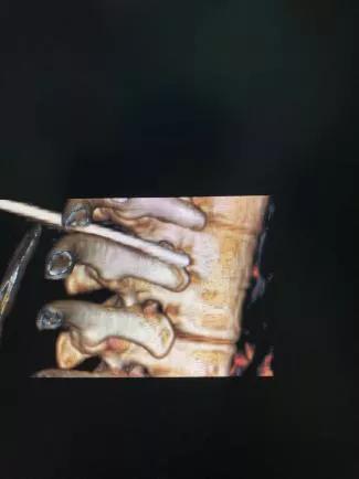 医院怎么确诊手汗症,广西手汗症治疗