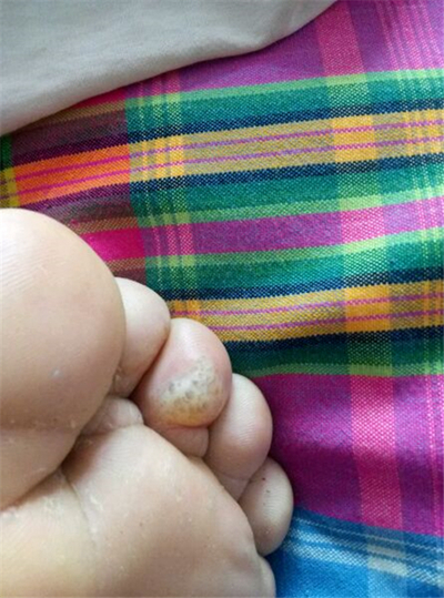 脚气反复发作其实是防治方法不对,脚气在治疗上的误区有哪些