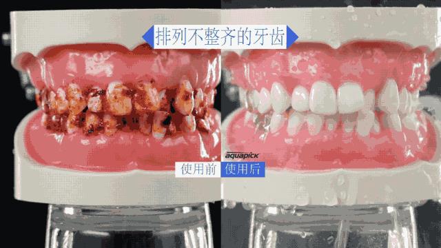 用冲牙器冲的牙很酸,用冲牙器后牙缝更大了