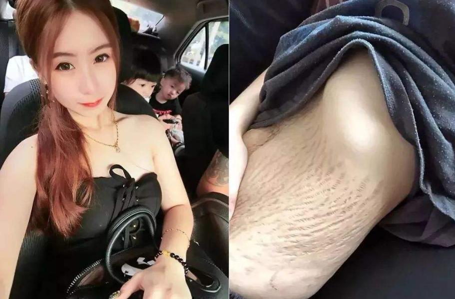 明星产后怎样护理妊娠纹,有多少妈妈产后肚子没有妊娠纹