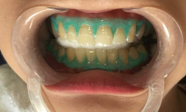 牙齿冷光美白，你了解多少？