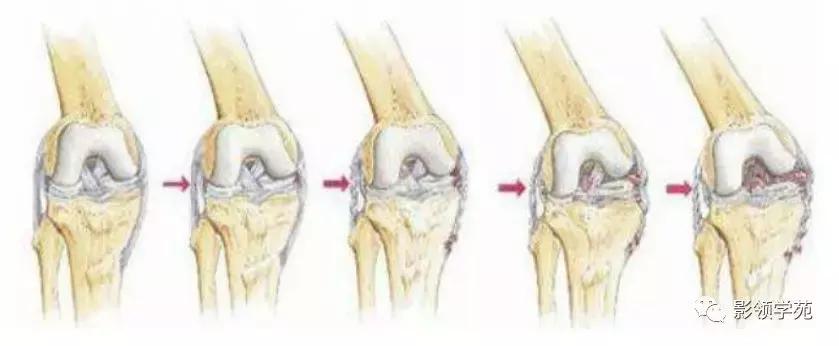 膝关节常见疼痛原因及其缓解方法,膝关节疼痛的16种最常见原因速查