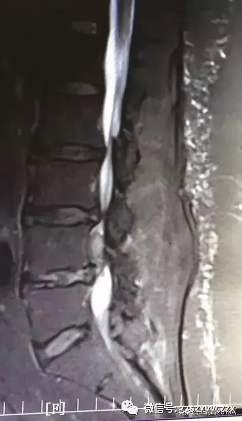 弯腰捡东西，腰痛腿麻大小便*禁失**，竞是腰椎间盘髓核脱出惹的祸